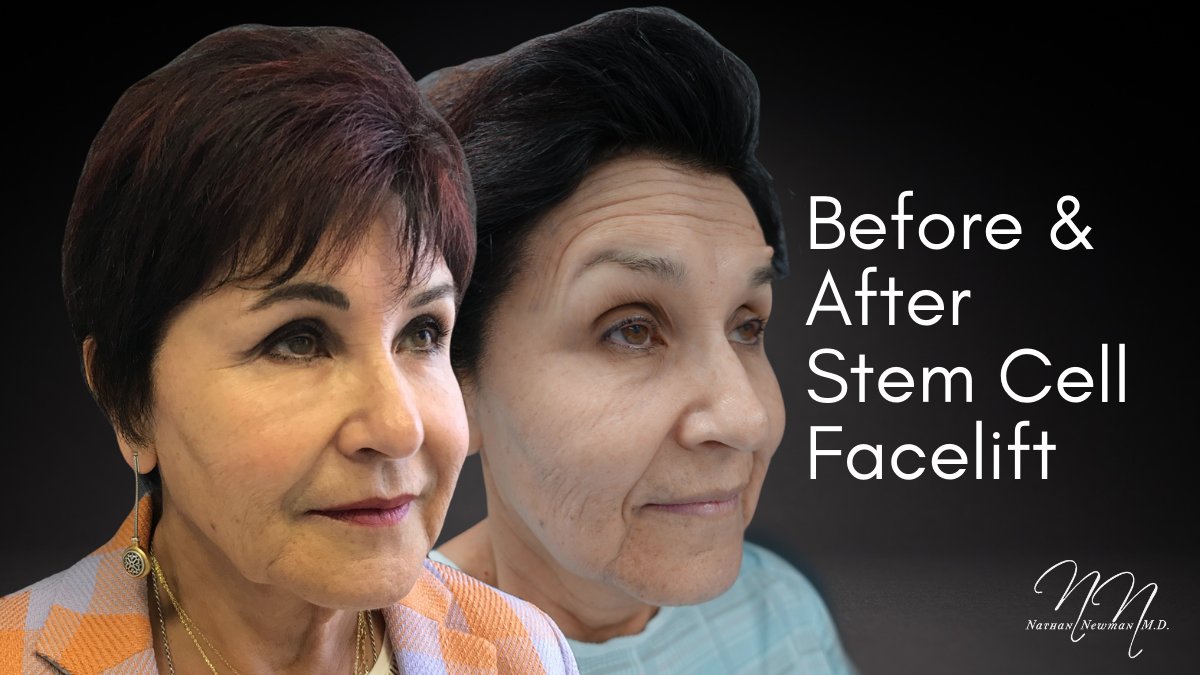 drnathannewman's tweet photo. A #StemCellFaceLift took years of aging away from this patient's face. Even as the years continue to pass by, she will look younger and younger as the stem cells rejuvenate and heal. Results like this are possible without any cutting or pulling.
https://t.co/30CAx3qUwX https://t.co/6TPBAnhSAq
