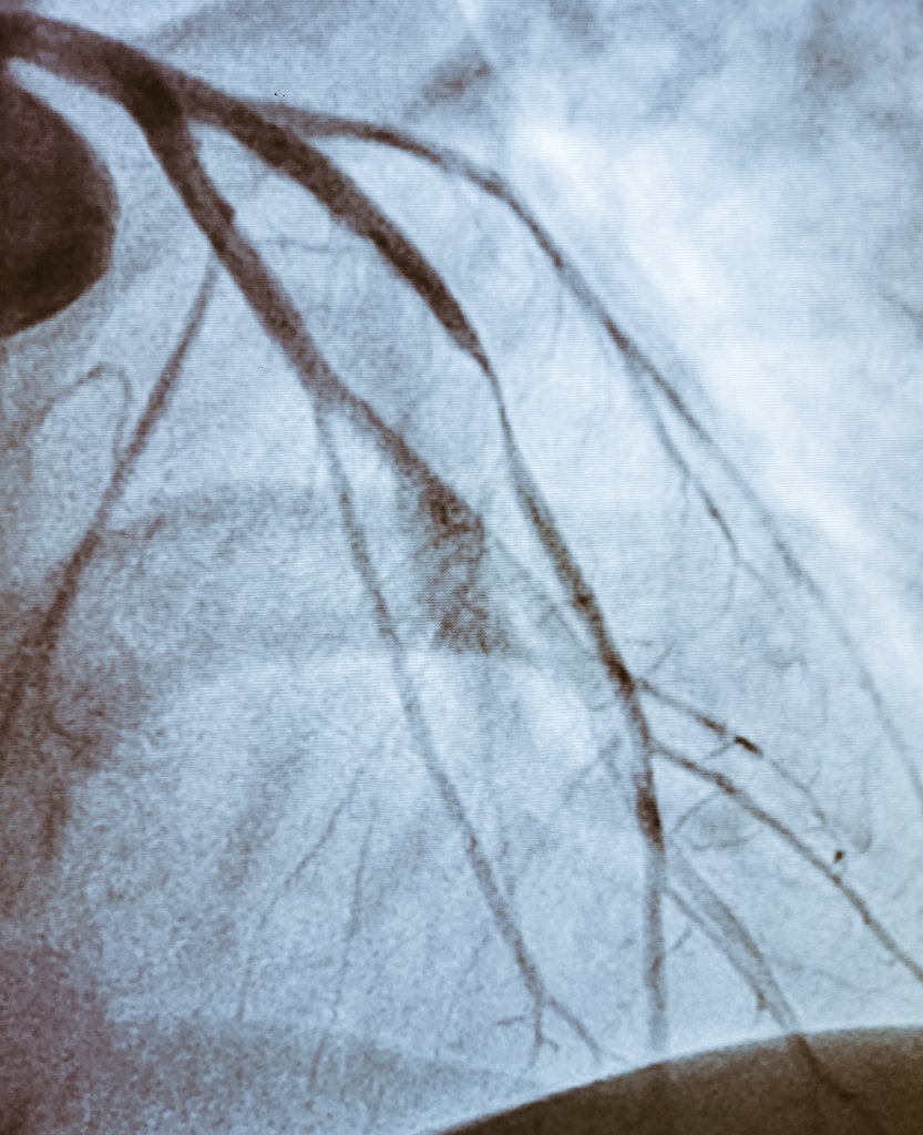 DrDeepakKrishn1's tweet photo. "20 year old" guy from WB, came with chest pain on exertion since last few days, obese (BMI 32.4) and diabetes detected a week ago. TMT abnormal. I reluctantly advised an angio which showed 90% blockage in LAD. Stented 🙌 #MedTwitter #YoungCVD #cardiotwitter https://t.co/xL2yDpYq0V