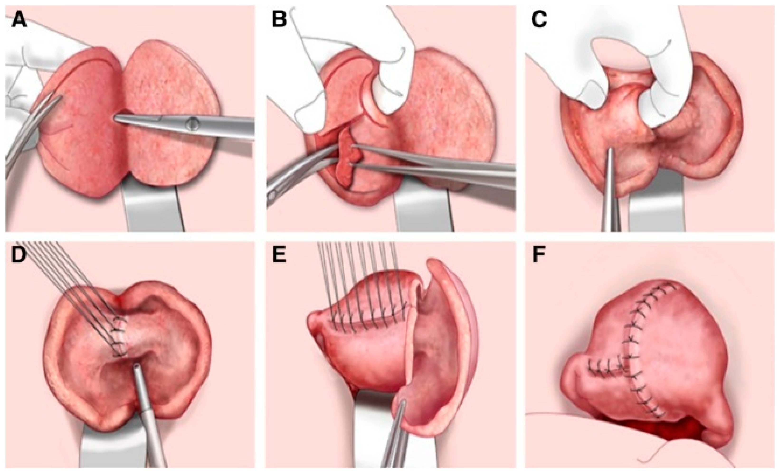 Adenomiosis causas