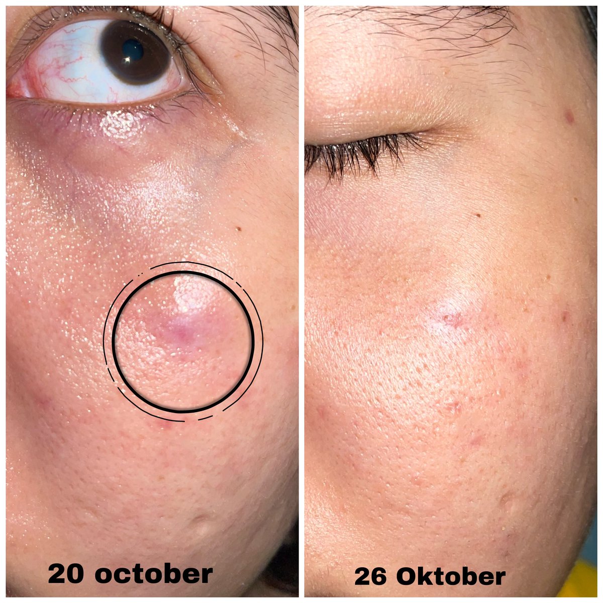 naaazzzs's tweet photo. aku mau share skincare rutin malemku selama 6 hari!! jerawat mendem plus redness ku hempas byebye😆 salah satunya pake produk niacinamide✨✨ ada yang bisa tebak gak, aku lagi pake niacin dari brand apa? (local) #racuninskincare https://t.co/0nQKIBNTcX
