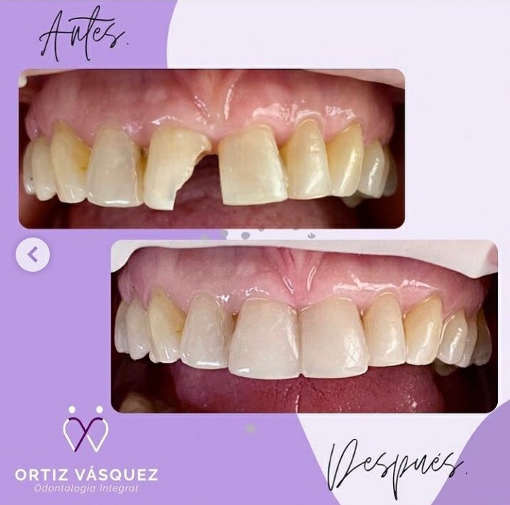 odontologiaOV's tweet photo. Carillas en resina técnica directa. Que nada te limite a lucir una linda sonrisa. 🦷💎✨
📍Citas 👇🏽
📱 @WhatsApp 322 9375263
📧 DM
#FelizMiercoles #FelizMiercolesATodos #Cali #CaloCo #Odontología https://t.co/h7SkRuKJT3