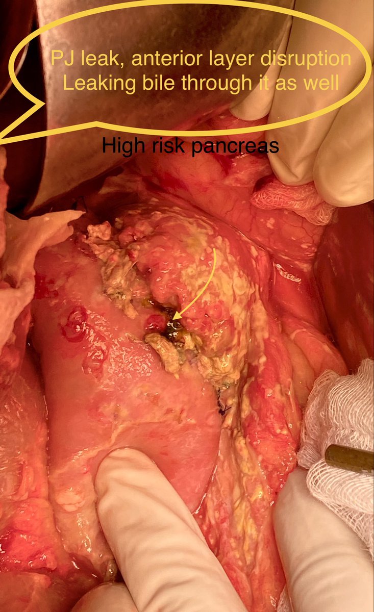 Uncommon, Unwanted, Unpleasant but have to be dealt by one and all #PancreaticSurgery

Dealt it today 😞👇🏻

What’s the best way out???
Disconnection with wirsungostomy or completion pancreatectomy

<a href="/IHPBA/">IHPBA</a> <a href="/hpb_so/">SoMe4HPB</a> <a href="/Shrikhande_SV/">Shailesh V. Shrikhande</a> <a href="/SyedAAhmad5/">Syed A. Ahmad</a> <a href="/MarcBesselink/">Marc Besselink</a> <a href="/surgery_hps/">Heidelberg Pancreatic Surgery (HPS)</a>