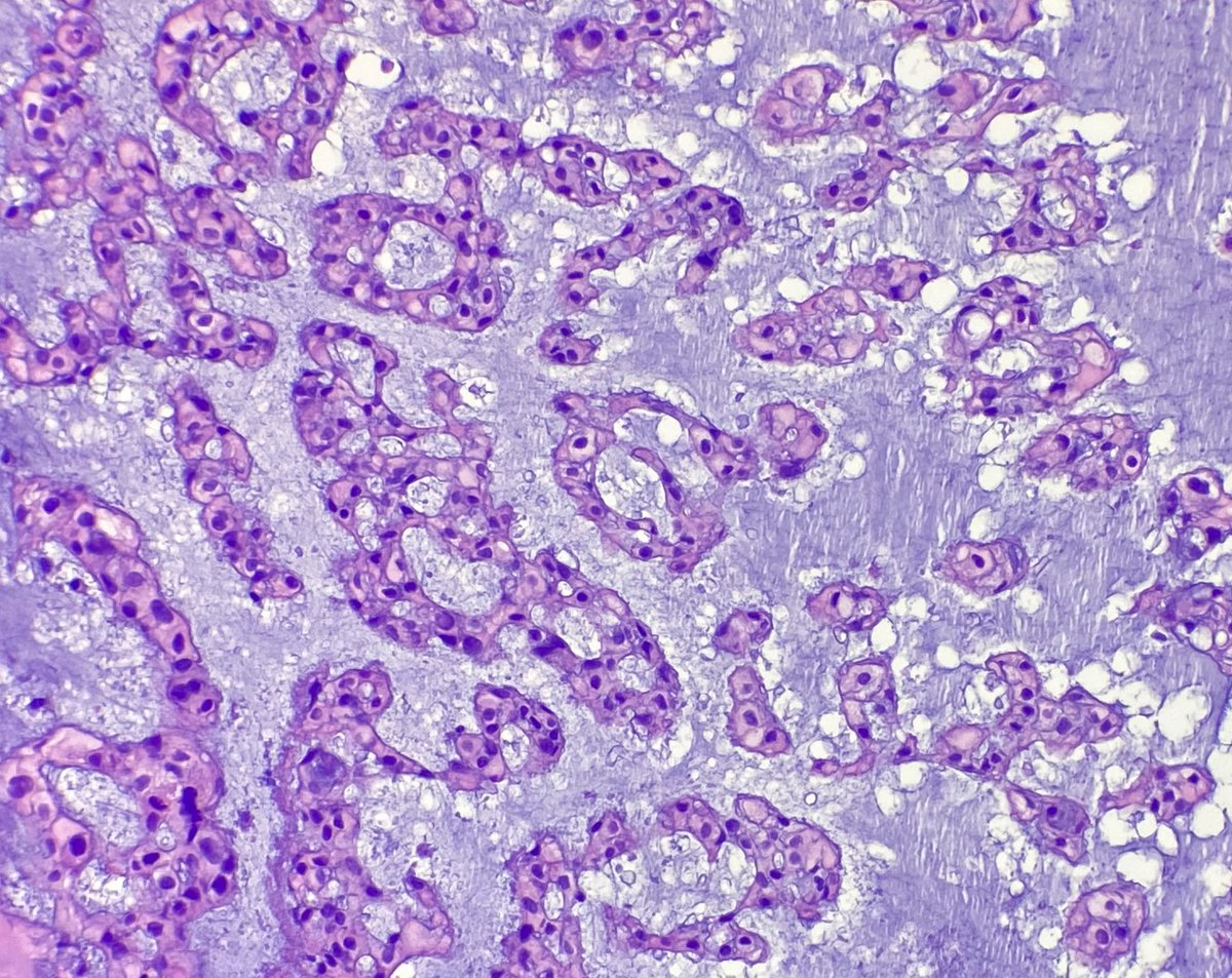 JCloutierMD's tweet photo. Sacral bone tumor with extension into soft tissue. #BSTpath https://t.co/l4SjXz9M3j