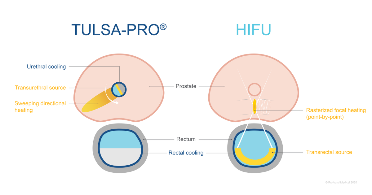 ProfoundMedical's tweet photo. The TULSA-PROยฎ system uses directional ultrasound to ablate prostate tissue, and HIFU uses focused ultrasound. To learn more about this and other differences, click here: https://t.co/o0SmeXTVwx
#urology #radiology #TULSAPRO #HIFU #ablatetheprostate #liveaprofoundlife https://t.co/ht5XSUODIp