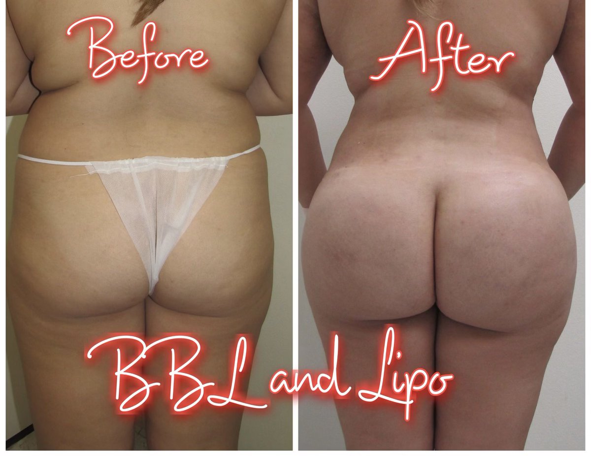 Get your BBL at Beauty Refined Plastic Surgery and feel great about you body. Call today 760-666-6121