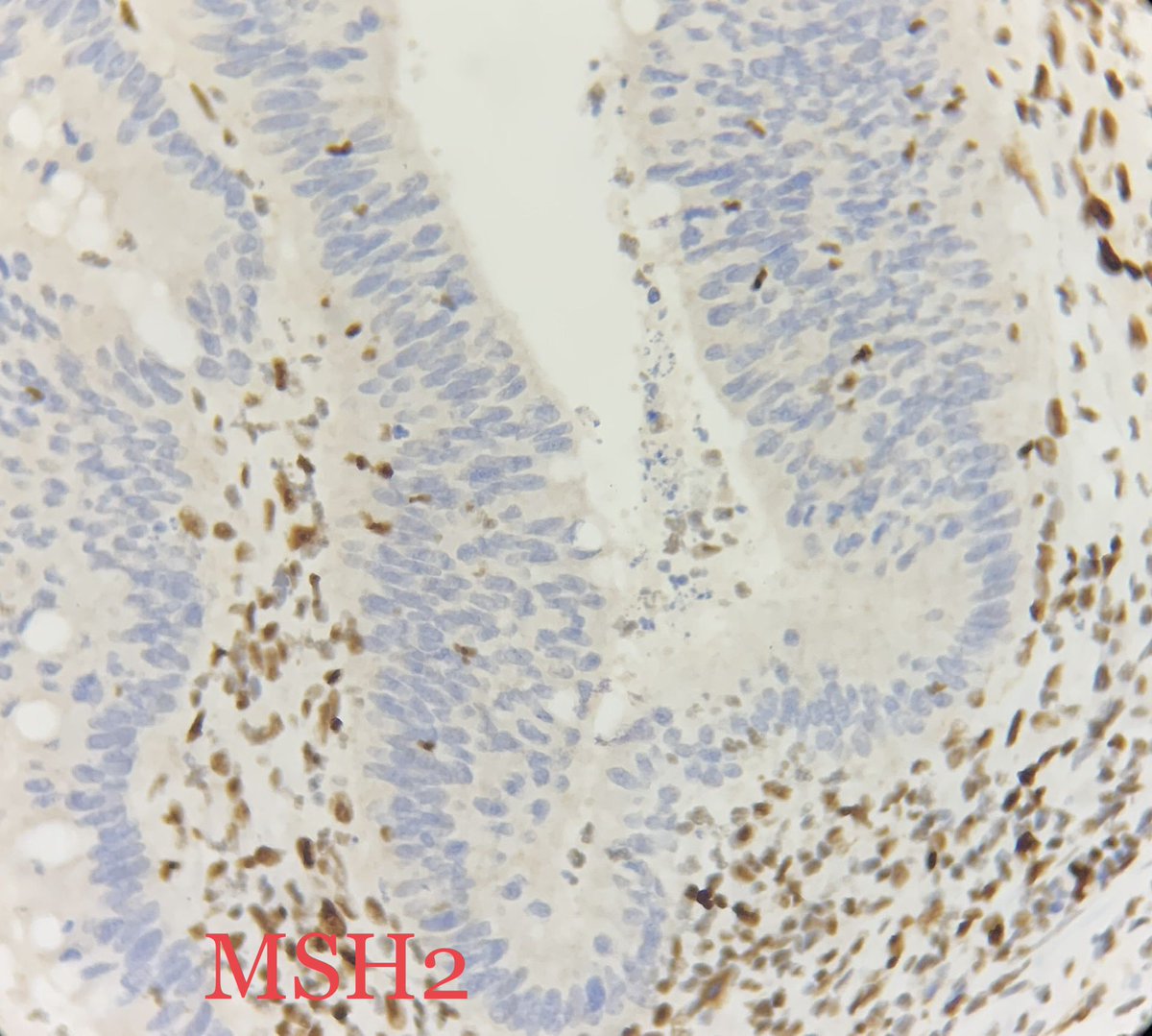 drparomitaroy's tweet photo. MSH IHC - retained or lost? What is your diagnosis? #GIpath #MMRihc #Lynch #mismatchrepair protein aberration #IHC https://t.co/iOR9zzBBCX