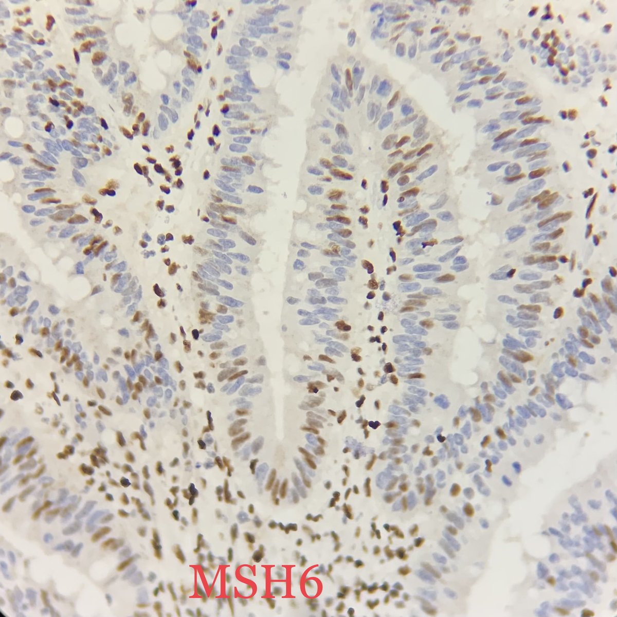 drparomitaroy's tweet photo. MSH IHC - retained or lost? What is your diagnosis? #GIpath #MMRihc #Lynch #mismatchrepair protein aberration #IHC https://t.co/iOR9zzBBCX