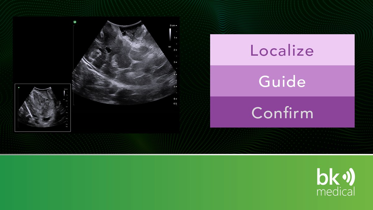 When using intraoperative ultrasound, #neurosurgeons can localize clots, guide catheter placement in real time and confirm hemostasis prior to closing. Learn more here: hubs.la/H0-8MJ70 #clarityinneurosurgery