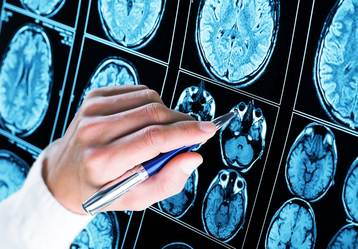 Weill Cornell Pediatrics (@wcmpeds) on Twitter photo A new review describes automated techniques to identify pediatric epilepsy surgical candidates, written by Dr. Jules Beal and <a href="/DrZachGrinspan/">Zach Grinspan, MD MS</a> of #WCMPeds and <a href="/nyphospital/">NewYork-Presbyterian</a> in collaboration w/ Dr. Debopam Samanta of <a href="/archildrens/">Arkansas Children's</a>. pubmed.ncbi.nlm.nih.gov/34620464 A new review describes automated techniques to identify pediatric epilepsy surgical candidates, written by Dr. Jules Beal and <a href="/DrZachGrinspan/">Zach Grinspan, MD MS</a> of #WCMPeds and <a href="/nyphospital/">NewYork-Presbyterian</a> in collaboration w/ Dr. Debopam Samanta of <a href="/archildrens/">Arkansas Children's</a>. pubmed.ncbi.nlm.nih.gov/34620464
