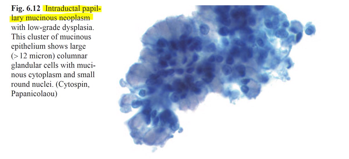 EMadrigalDO's tweet photo. When life imitates the textbooks. 🔬 📚 #textbookExample
Intraductal papillary mucinous neoplasm #IPMN #cytoPath
CC: @marthabpitman @MLisaZhang @PapSociety @MGHPathology https://t.co/KfLtPhdY8B