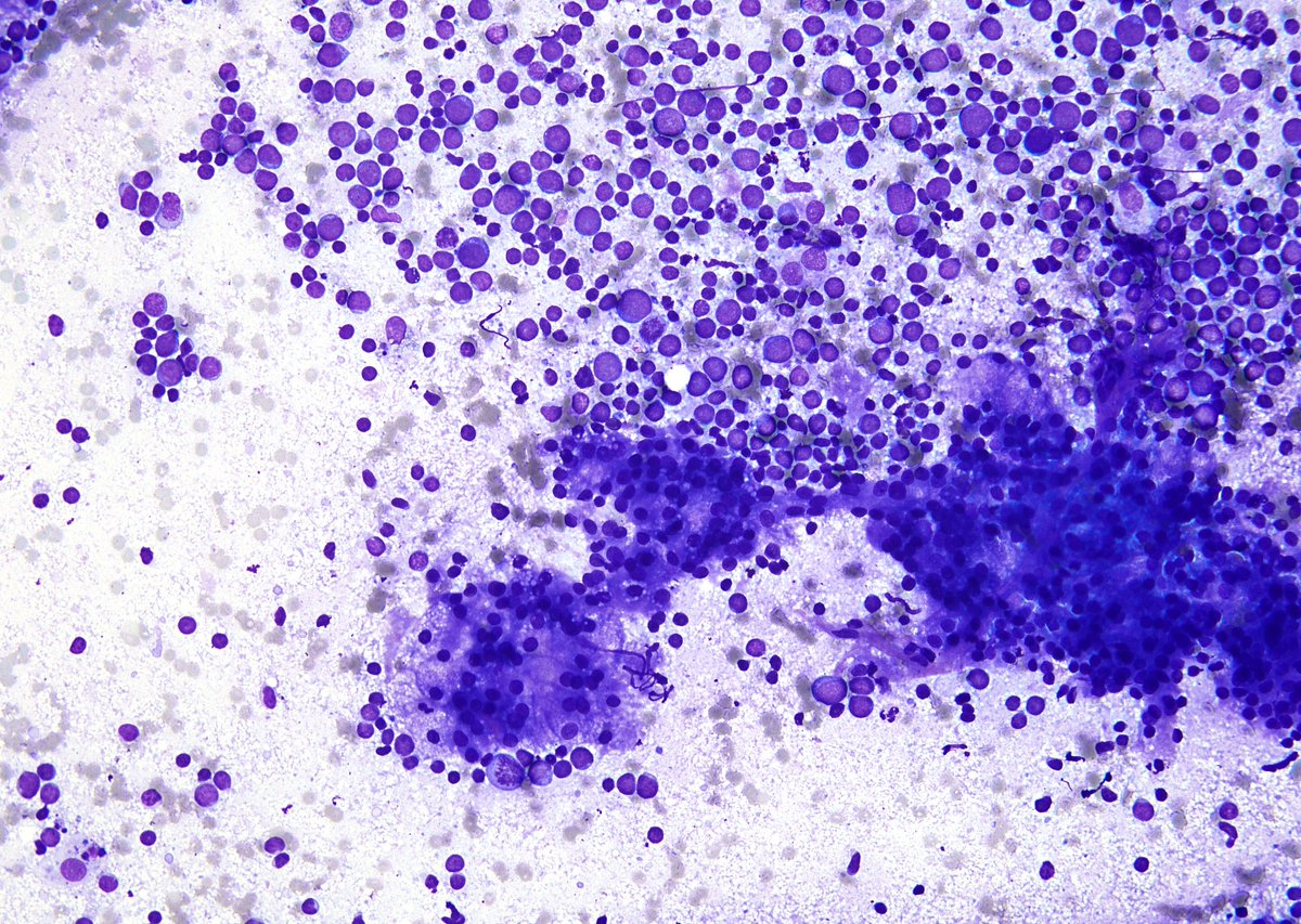 sza_jhcyto's tweet photo. A Parotid "Acinic Cell Carcinoma (ACC)" obscured by abundant reactive lymphocytes ("TALP" - Tumor associated lymphoid proliferation). Still in my experience, TALP is much more common and pronounced in FNAs of Mucoepidermoid CA than ACC. https://t.co/bGgJL4E24q