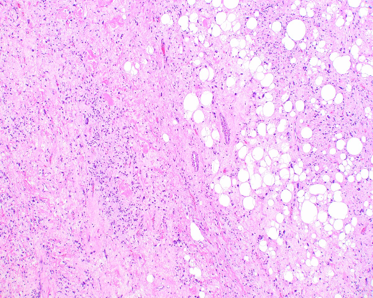 LizMontgomeryMD's tweet photo. A lovely well-marginated subcutaneous pleomorphic lipoma; it is a delightful diagnosis to make - so splendid under the microscope and the patient has a benign neoplasm! Fleurette cells, wiry collagen, and mast cells, oh my! https://t.co/DEen0ROy4Y