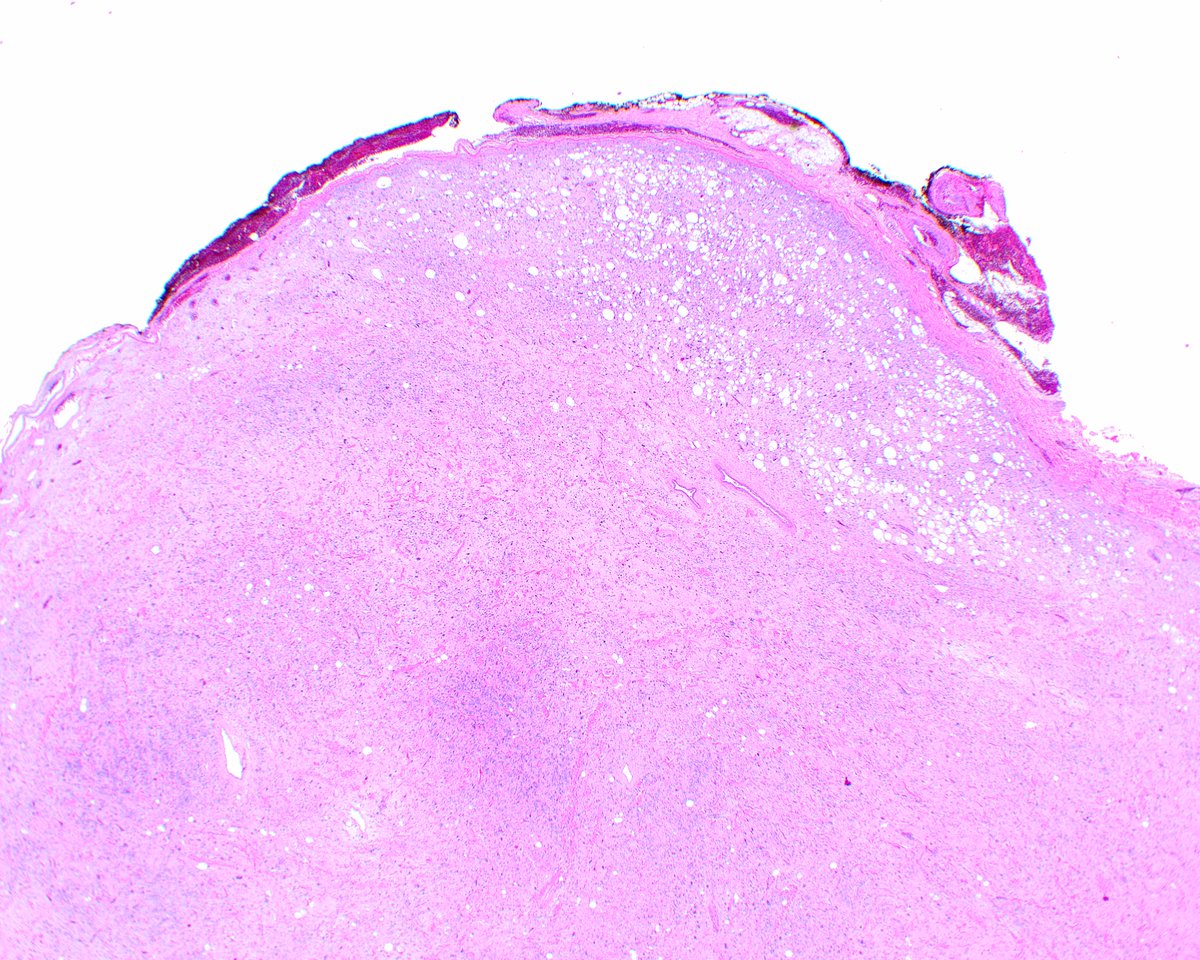 LizMontgomeryMD's tweet photo. A lovely well-marginated subcutaneous pleomorphic lipoma; it is a delightful diagnosis to make - so splendid under the microscope and the patient has a benign neoplasm! Fleurette cells, wiry collagen, and mast cells, oh my! https://t.co/DEen0ROy4Y