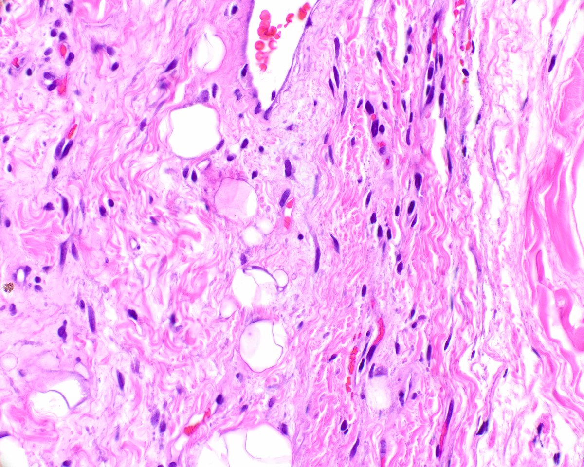 LizMontgomeryMD's tweet photo. A lovely well-marginated subcutaneous pleomorphic lipoma; it is a delightful diagnosis to make - so splendid under the microscope and the patient has a benign neoplasm! Fleurette cells, wiry collagen, and mast cells, oh my! https://t.co/DEen0ROy4Y