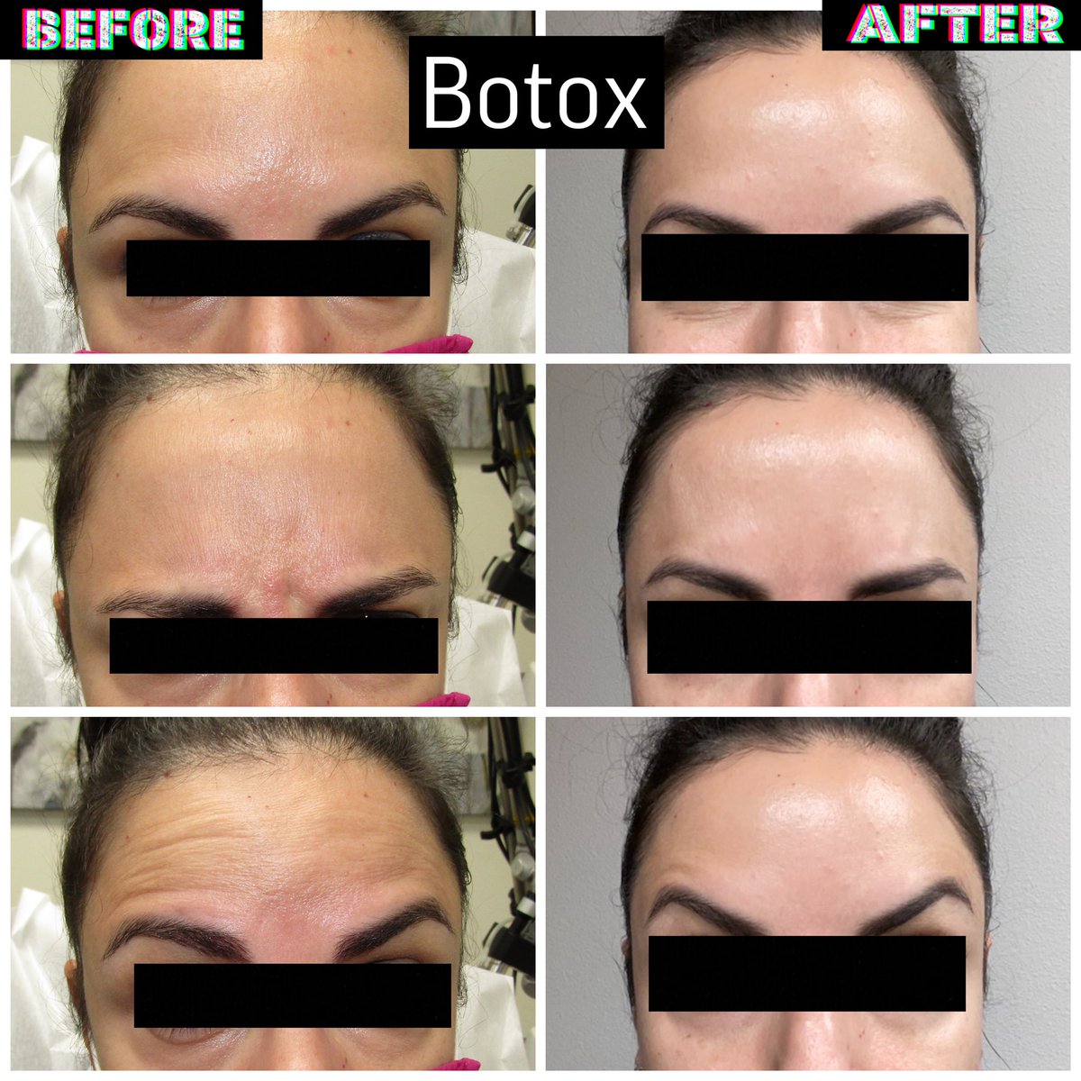 Don’t forget we are here for your Botox needs. Call us today 760-666-6121