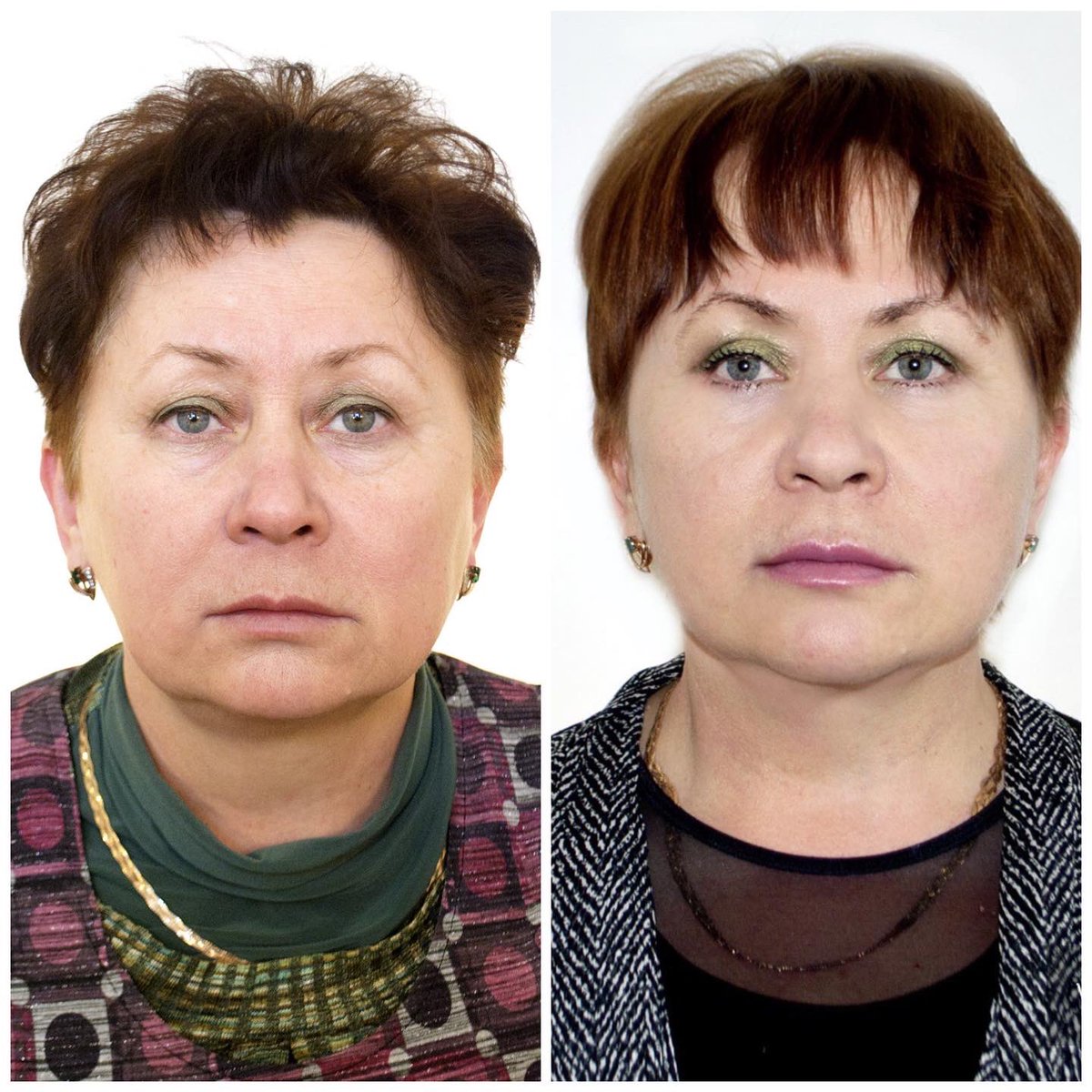 #фейслифтинг — самый эффективный способ устранить видимые возрастные изменения.

Во время операции задействованы мышцы лица, а не только верхние слои кожи. При этом мимика остаётся живой и активной. В <a href="/dl_clinic/">Медицинский центр DLclinic</a> вы получите естественный результат без эффекта маски.