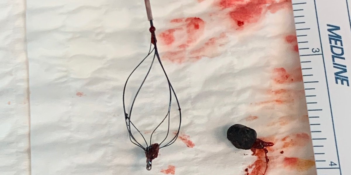 UC San Diego Interventional Radiology (@ucsd_ir) on Twitter photo IR spyglass endoscopy success. 👌<a href="/Quinn_Meisinger/">Quinn Meisinger MD</a> and <a href="/JulieAnMD/">Julie An</a> removing a biliary stone causing cystic duct obstruction in a poor surgical candidate pt with hx of gangrenous cholecystitis. <a href="/UCSDRadRes/">UCSDRadRes</a> <a href="/SIRRFS/">SIR RFS</a> #IRad IR spyglass endoscopy success. 👌<a href="/Quinn_Meisinger/">Quinn Meisinger MD</a> and <a href="/JulieAnMD/">Julie An</a> removing a biliary stone causing cystic duct obstruction in a poor surgical candidate pt with hx of gangrenous cholecystitis. <a href="/UCSDRadRes/">UCSDRadRes</a> <a href="/SIRRFS/">SIR RFS</a> #IRad
