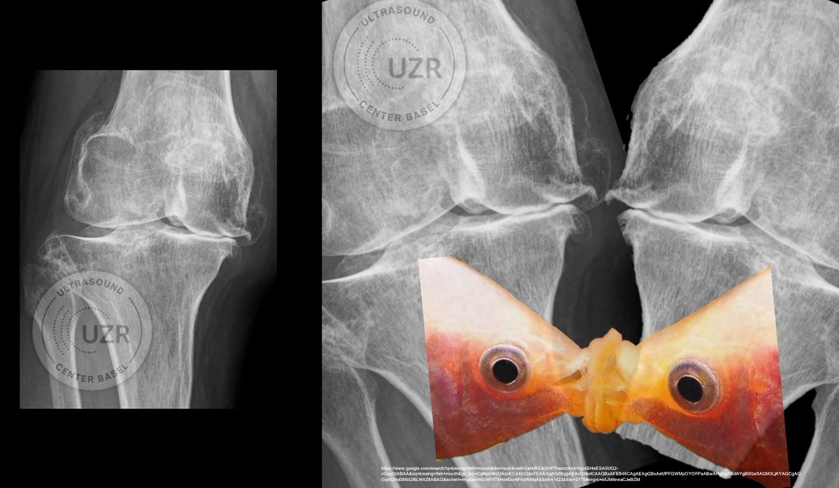 "KISSING FISH SIGN"

advanced knee osteoarthritis with kissing fish sign