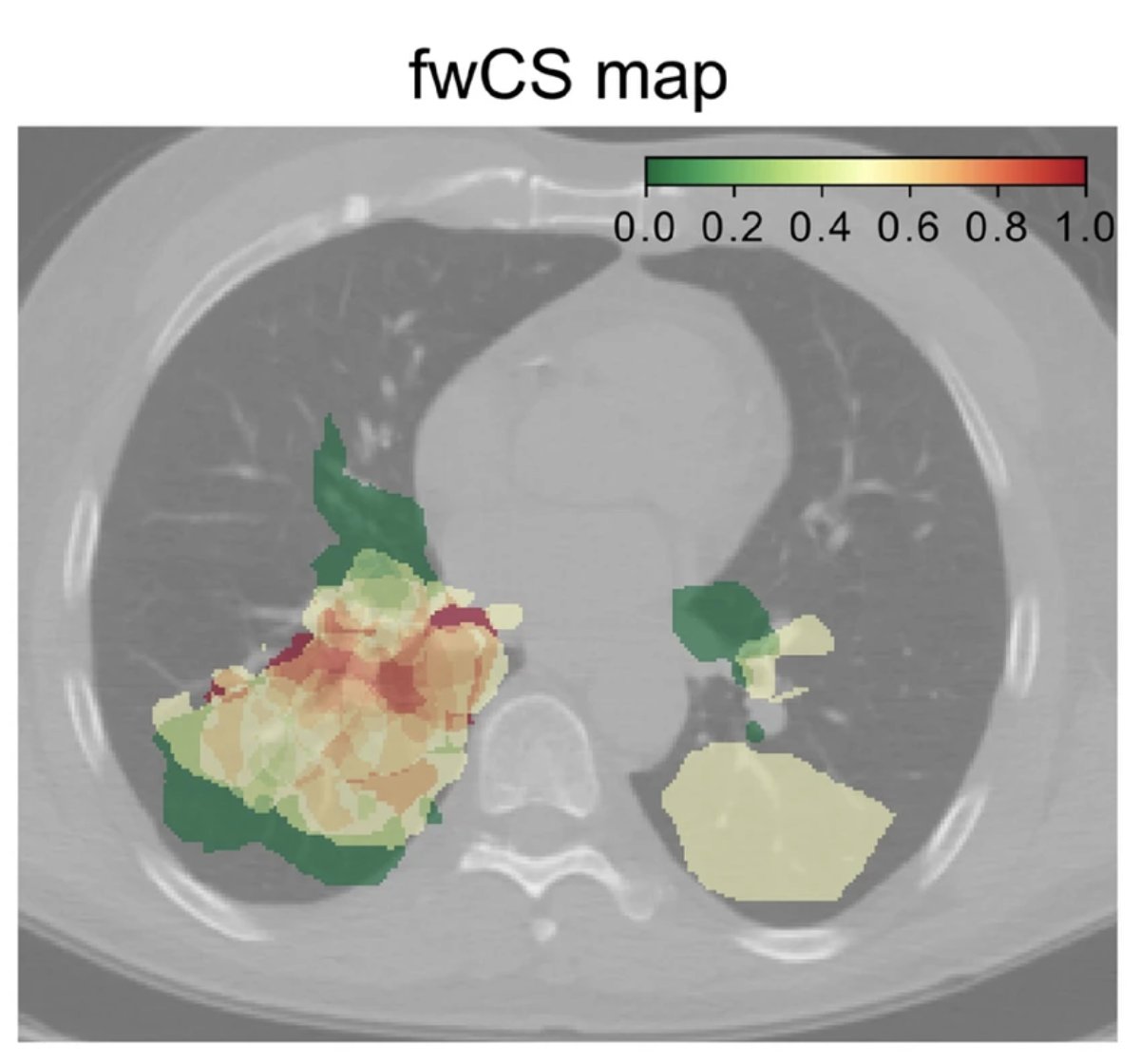 Mat_Guc's tweet photo. One challenge in stage III NSCLC: huge heterogeneity of local &amp; regional growth
Our recent study developed a methodology to use the voxel-by-voxel spatial distribution of the primary as a  biomarker
👉 Proof-of-principle successfully demonstrated
#Radonc
https://t.co/X79HJaMccP https://t.co/477DVaBIwA