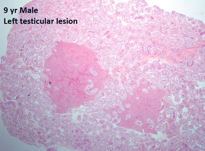 DrTravisBrown's tweet photo. Histology testis flash card

Leydig cell tumour

Most common sex-cord stromal tumour
1-2% testicular tumours
Any age (av 20-60yrs)

Testicular mass
Oft asymp
15% pts gynaecomastia

Majority benign
5% malig -> features >5cm, cyto atypia, >3mt/10hpf, vas inv, necrosis

#PathTwitter https://t.co/BGw4A1UwWC