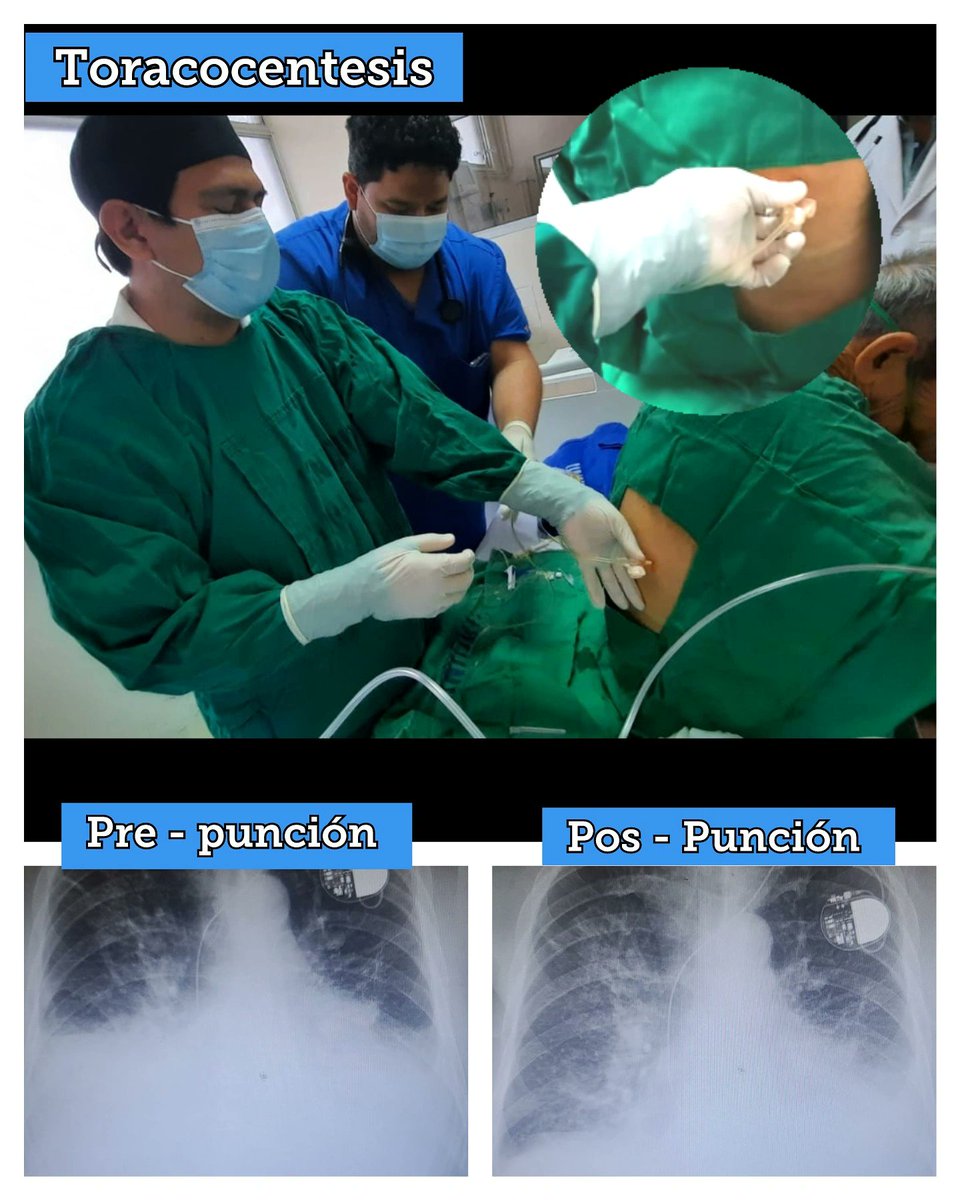euroboy333's tweet image. 💉 #toracocentesis
#thoracocentesis 
#thoracic 
es un Procedimiento usual para dar alivio a 1 paciente con 
🤕 #insuficienciacardiaca
#icc
en este caso portador de un
⏱ #marcapaso 

se consiguió aliviar su 
😰 #disnea al drenar líquido del espacio #pleura

#pleuraleffusion
