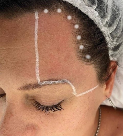 In this How I Do It feature for our Aug / Sep 21 edition > bit.ly/3nV6Utd Adrian Gaspar reveals his take on Er:YAG treatment for eyebrow tail elevation and upper eyelid rejuvenation