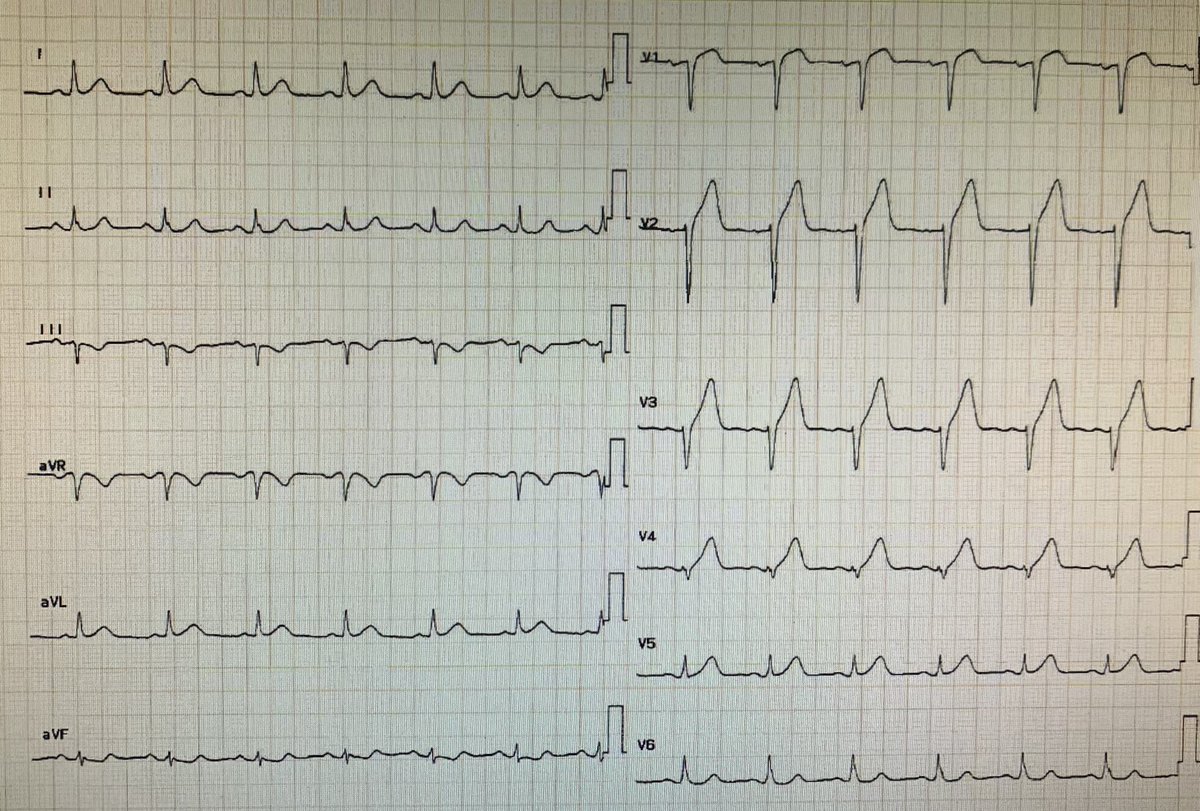 Très fier de l’infirmière d’accueil qui devant une douleur thoracique typique à fait l’ECT dans le box d’accueil et est venue me voir (alors que je n’étais pas MAO) car elle savait que j’y prêterais attention. 
45 min après son arrivée aux urg le patient était en USIC.