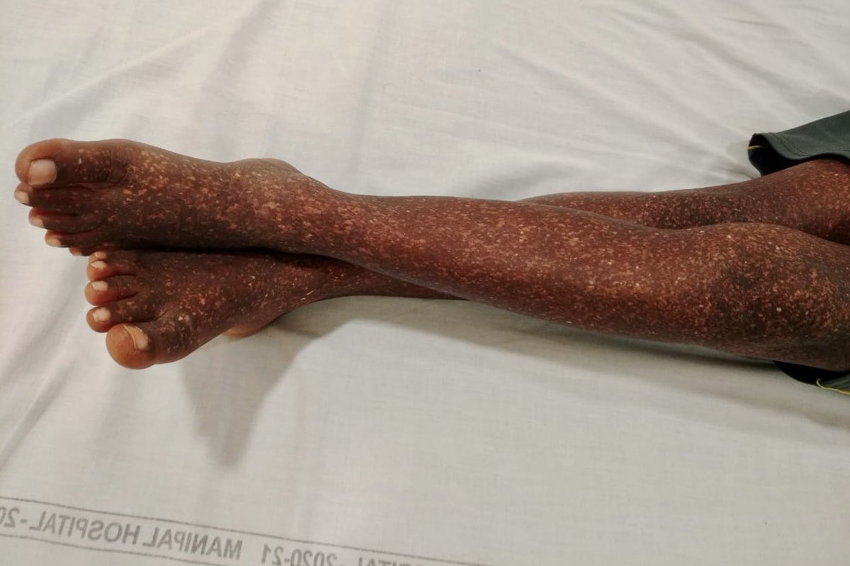 docdanthala's tweet photo. Pancytopenia + reticular skin pigmentation. https://t.co/9BdxgxJZMx
