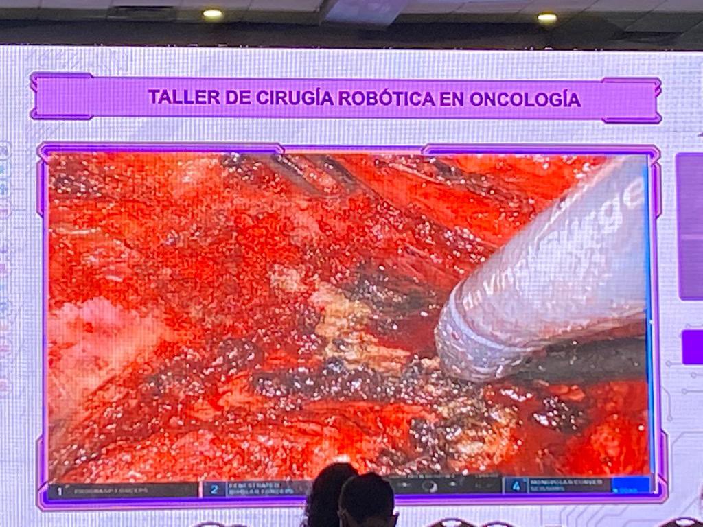OncoMerida's tweet photo. Cirugía robótica 
En resección anterior baja, linfadenectomia retroperitoneal, y en tratamiento quirúrgico de cáncer de endometrio y cáncer de ovario. 

Presente en #Congreso2021 #SMeO #Oncología https://t.co/T2DmYbqIug