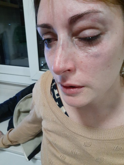 javierlanari's tweet photo. Curioso. El colectivo feminista en ningún momento se solidarizó con Bárbara Marcotegui. Fue pareja de Luis Tagliapietra. Hace unos meses lo denunció por violencia de género. La desfiguró a trompadas. Si no se enteraron acá la prueba que ella misma publicó... https://t.co/8N6i8IOJYk