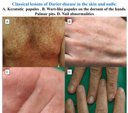 Darier's disease, dermoscopy - Stock Image - C057/1884 - Science Photo  Library