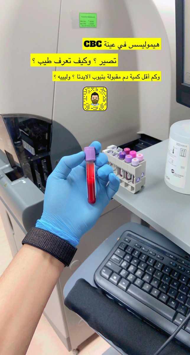 Rani_lab's tweet photo. ١- هل ممكن ترفض عينة CBC بحجة إنها Hemolysis ؟

لا ، والسبب انه عينة ال CBC فيها على الاقل ٢ مل دم .. يعني تقريباً ٦ مليار خلية Rbc اذا تكسرت بعض الخلايا ماراح يأثر على نتيجة العينة بالجهاز

٢- ليه كمية الدم في عينة CBC لازم تكون على الأقل 2 مل في تيوب الايدتا ؟

#مختبرات_طبية 🔬 https://t.co/B89nXhlYkG