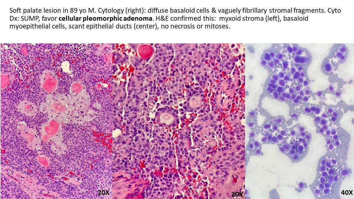 Soft palate lesion in 89 yo M. Cytology (right): diffuse basaloid cells &amp; vaguely fibrillary stromal fragments. Cyto Dx: SUMP, favor cellular pleomorphic adenoma. H&amp;E confirmed this:  myxoid stroma (left), basaloid myoepithelial cells, scant epithelial ducts (center).