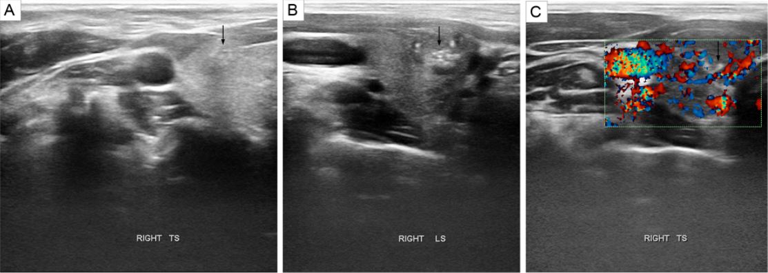 EDMCaseReports's tweet photo. Don't miss this @Soc_Endo member case report, which identifies #microcalcifications without a #thyroid nodule as the sole sign of papillary thyroid carcinoma.

https://t.co/S2rA1hjmYX https://t.co/wnaWQtBUbo
