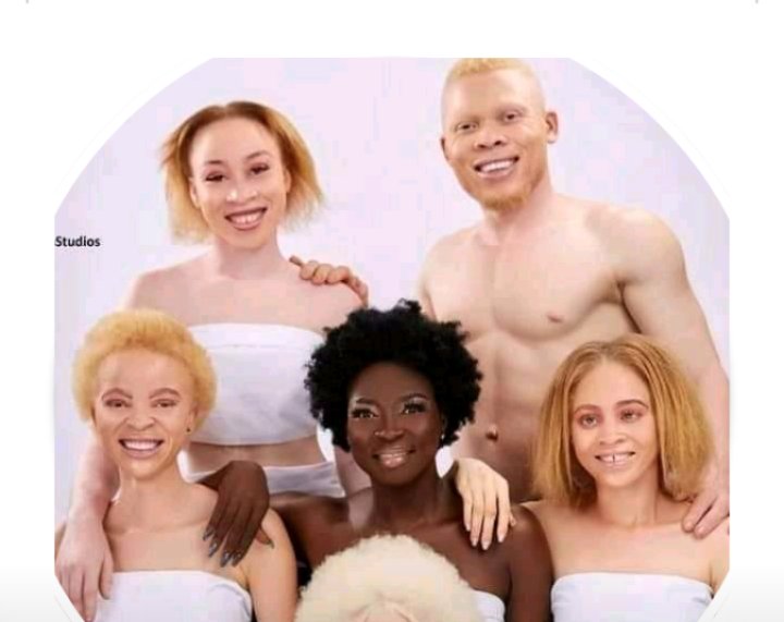 DOSSOURichard9's tweet photo. Non à la violence et à toutes formes de discriminations envers les personnes Albinos. Nous sommes comme vous. Ce n'est que la couleur de la peau qui change @unfpa_benin @RuthBoko @AgnandjiMonique @patrice_talon @PlanIntlBenin @francediplo @Figaro_Live @ortb_info @TV5MONDE https://t.co/9dGRvwJ1On