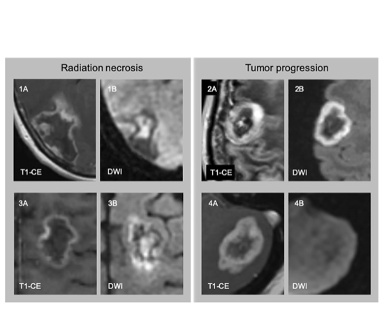 JNeurooncol's tweet photo. Radiation necrosis may be hard to differentiate from tumor progression in brain metastases following #SRS.  Absence of a centrally restricted diffusion sign on MRI is associated with a low probability of radiation necrosis.  #JNO #BTSM @NSTumorSection https://t.co/ILSLeR5zIZ https://t.co/EkOGTjpOii
