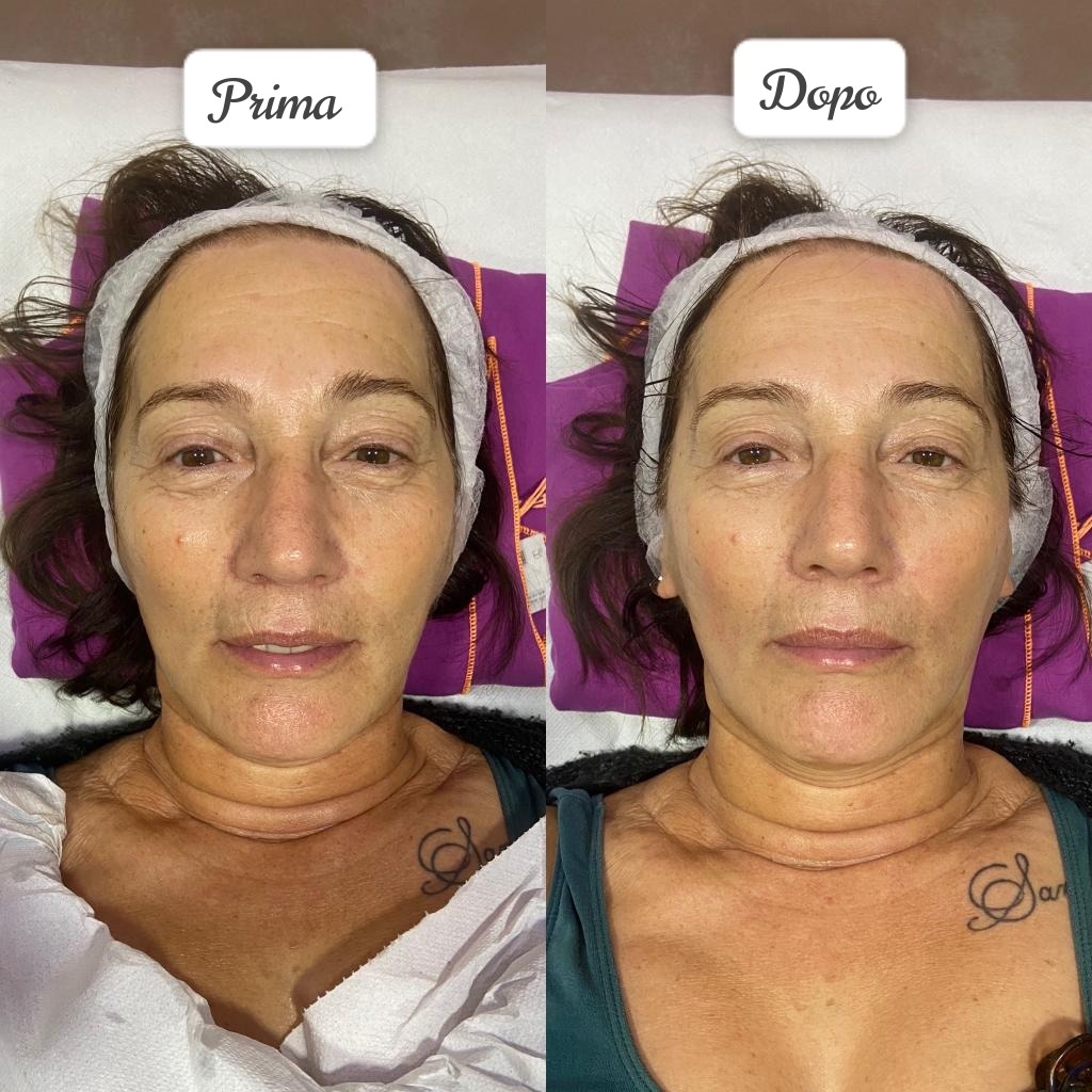 BeautyofImage1's tweet photo. TRATTAMENTO ANTI-AGE
-IDROS richiama i liquidi verso l'alto
-EXEMAR per una pulizia profonda
-4SHAPE
-ISOIDROS fiala con proprietà nutrienti e stiranti
📍Cosa aspetti, vieni a provare anche tu il nuovo trattamento
#beautyofimage #beautyandwellness #beautyandthebeast https://t.co/TT3gWBsa5x