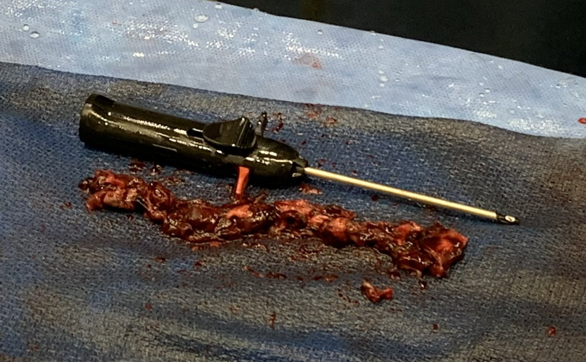 JaafGolzar's tweet photo. #alphavac saga continues w IVC thrombus. 11th global case of this exciting technology. I’m blow away by the aspiration power,  rapid intake of large thrombus volume. Truly incredible @JosieMbex @AngiovacAmy https://t.co/SVh9wRUsmH