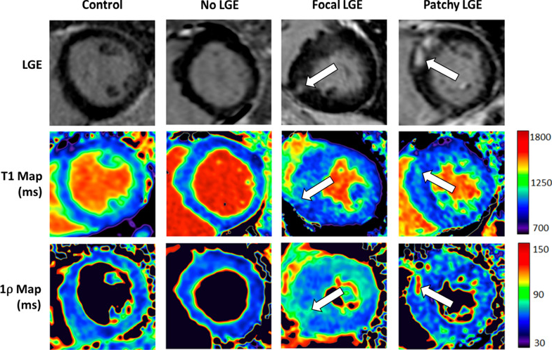 walterwitschey's tweet photo. Kudos @bethwthompson #yuchihan for their report on T1rho CMR in hypertrophic cardiomyopathy.
#whyCMR #HCM @SCMRorg
https://t.co/SUHSItXAxn https://t.co/9Ntyh7Kblt