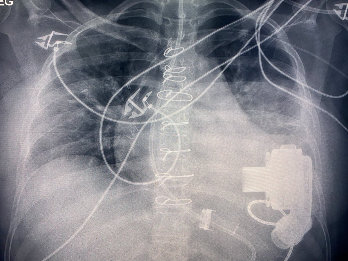 Fun case with physical workout included - removal of surgical port &gt;10 yrs old. Catheter thoroughly adherent in SCV, couldn’t pull from venotomy side. 14 Fr sheath from femoral vein, thru&amp;thru wire, snare and LOTS of muscle: success! #IRad #TwittIR