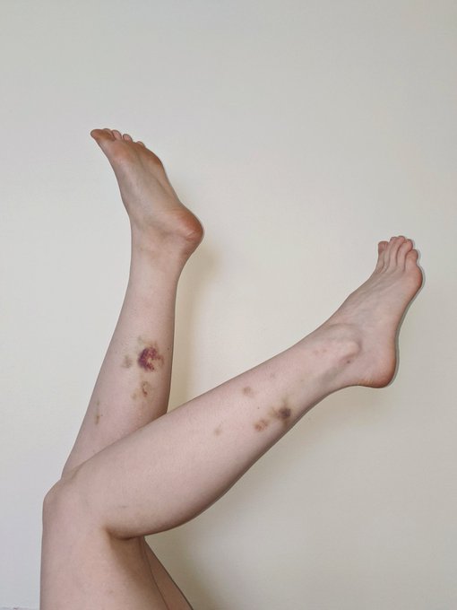 Bruises from my move. I'm delicate. 😌 https://t.co/zAw6EHsWK0<a href="/tag/onmfc"class="tags"><span>#onmfc</span></a>