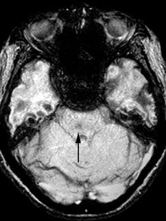 Capillary Telangiectasia

🎯 Low flow vascular lesion
🎯 Most commonly located in the pons
🎯 Associated with Osler-Weber-Rendu
🎯 Brush-like enhancement on T1 C+
🎯 Marked loss of signal on GRE sequences

#radres #FOAMrad #RadEd #MedEd #neuroscience #neurotwitter #Neurosurgery