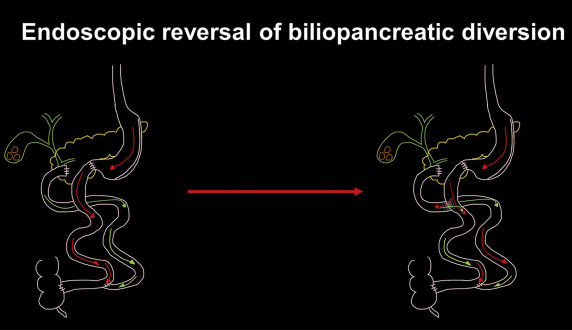 VideoGIE Journal (@videogie) on Twitter photo Manol Jovani et al present "Switching the switch: endoscopic reversal of a biliopancreatic diversion," a recent case report published by VideoGIE. videogie.org/article/S2468-…
<a href="/JovaniManol/">Manol Jovani, MD MPH</a> <a href="/MouenKhashab/">Mouen Khashab, MD, MASGE</a> <a href="/BejjaniMichael/">Michael Bejjani</a> <a href="/BachirGhandour/">Bachir Ghandour</a> Manol Jovani et al present "Switching the switch: endoscopic reversal of a biliopancreatic diversion," a recent case report published by VideoGIE. videogie.org/article/S2468-…
<a href="/JovaniManol/">Manol Jovani, MD MPH</a> <a href="/MouenKhashab/">Mouen Khashab, MD, MASGE</a> <a href="/BejjaniMichael/">Michael Bejjani</a> <a href="/BachirGhandour/">Bachir Ghandour</a>