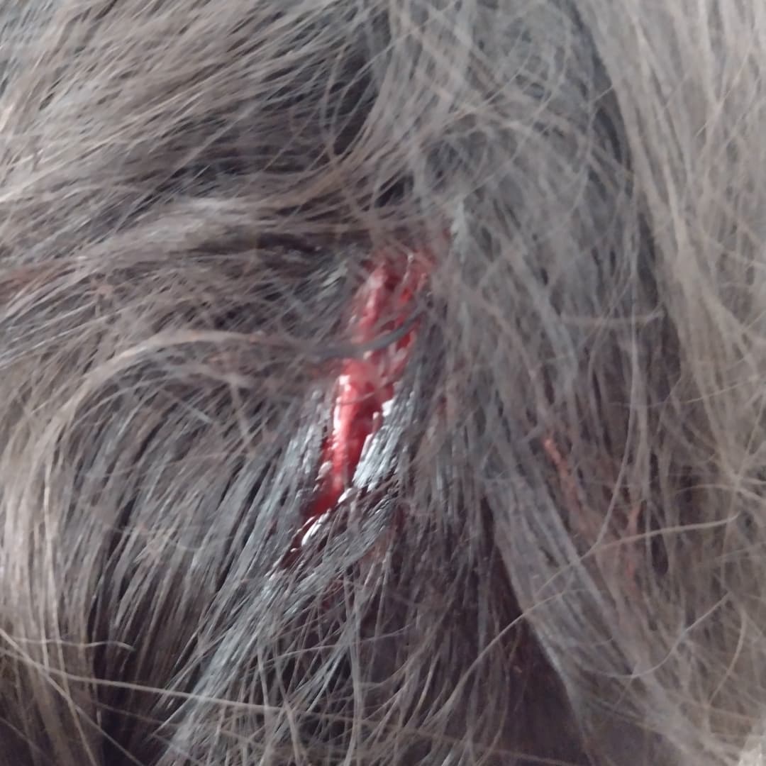 marcelo96754866's tweet photo. Éste es el corte que sufrio mi hija tras la caída de una ventana en la escuela 5 de calle darregueira al 400. En plena hora escolar se desplomó el vidrio completo y el marco, dando de lleno sobre la cabeza de mi nena. https://t.co/ipwGK4ZY7o
