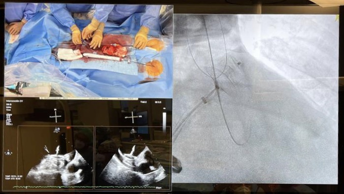 CARDIVAGROUP's tweet photo. El equipo de Hemodinámica del HULA de Lugo realiza su primera intervención con protección embólica cerebral completa de los tres vasos supra-aórticos con el dispositivo de #KeystoneHeart en cierre de orejuela izquierda #COI https://t.co/tBpfXewFng
