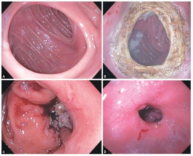 Endoscopic Management of Obesity 2020
jpmer.com/doi/JPMER/pdf/…

#AspirationTherapy #IntragastricBalloons #EndoscopicSleeveGastroplasty #Endoscopy #BariatricTherapy #Obesity #JPMER #TrupteshHKothari #MSDhillon #PGIMER #JaypeeJournals #JaypeeBrothersMedicalPublishers