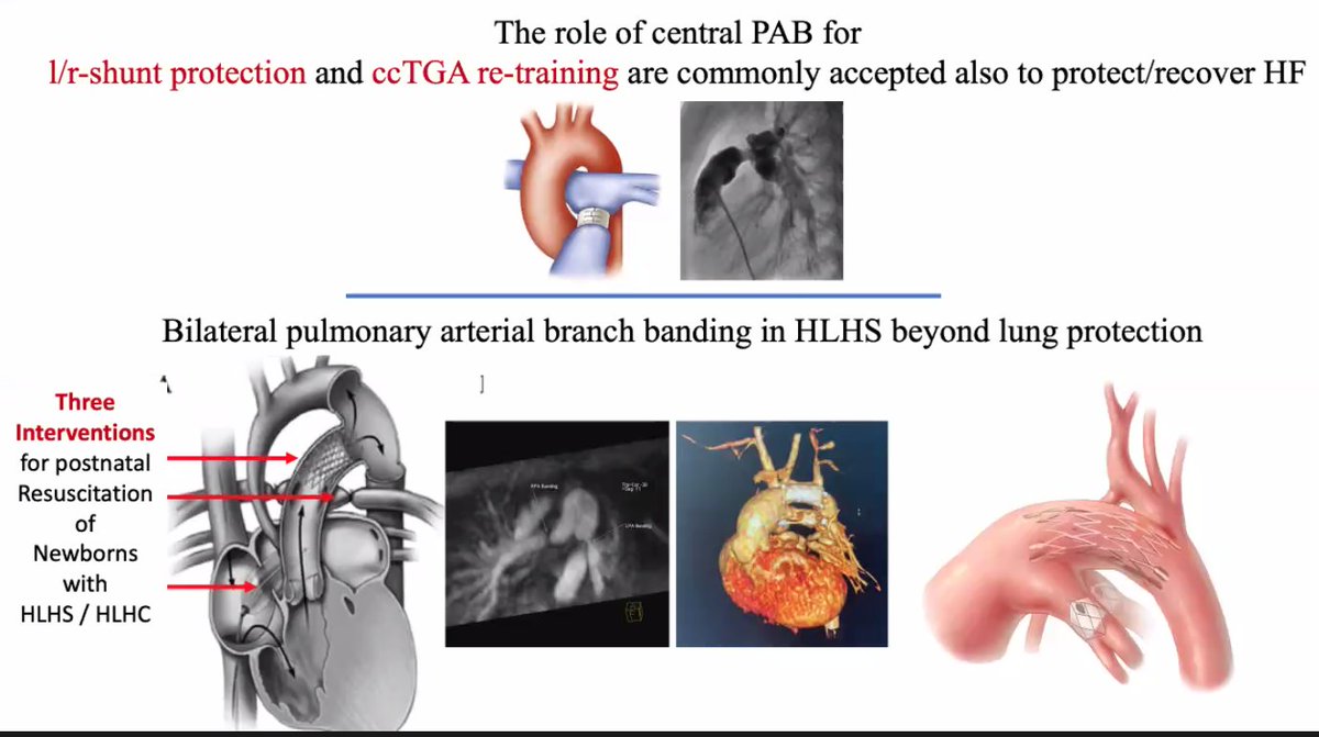 PICJournalWatch's tweet photo. #PAband #BCHCardiac21 #PedsICU #PedsCICU 

PA band for heart failure

Dietmar Schranz, Frankfurt
@jvc2006 @drzaf_pic @Bham_Childrens https://t.co/RsZBErFoKc