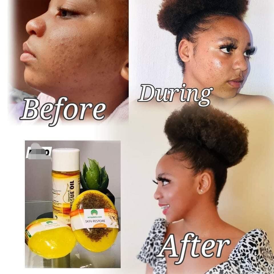 Peshmellow's tweet photo. Skin problems? I have a solution for you. Try Umgalelo Products and restore your confidence. We deliver for FREE around Soweto and Johannesburg cbd. To place an order please WhatsApp me on 0787542221 https://t.co/qhbHuQgfPh