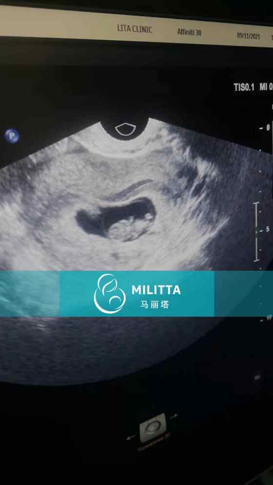 BinStruggle's tweet photo. *客户的sm孕期第二次B超，孕囊正茁壮成长 #乌克兰代孕 #Ukraine #surrogacy https://t.co/U5bEWzY89P