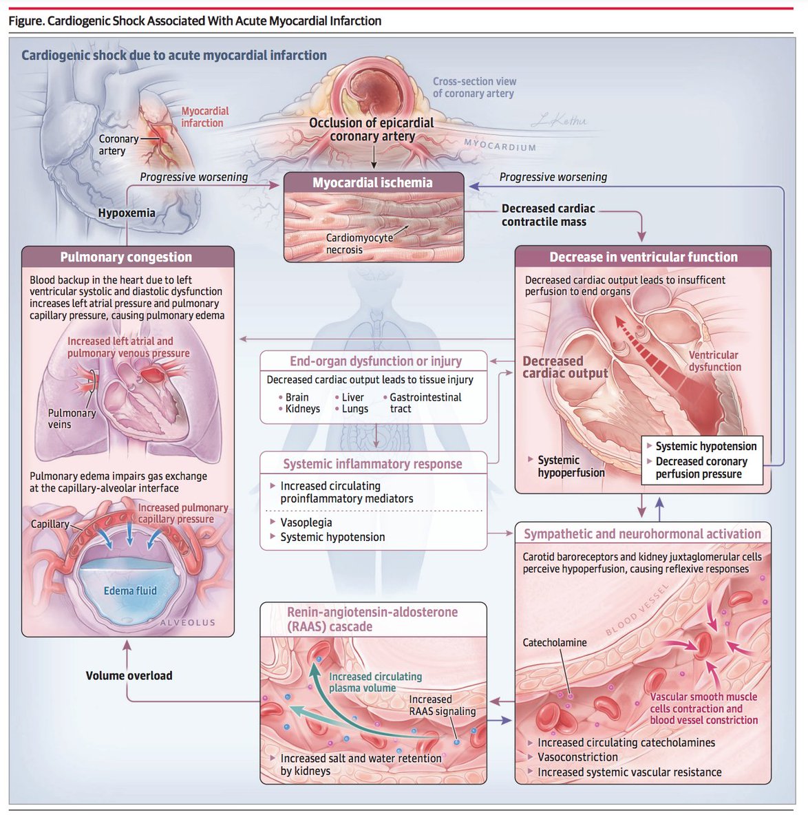 Ed_Alania's tweet photo. 🔴Cardiogenic Shock After Acute Myocardial Infarction A Review @JAMACardio @marcsamsky @SVRaoMD @ICUDocAP @thiele_holger #CardioEd #Cardiology @SVCardio @torresviera @Steph_Achenbach @sabeedak1 @Drroxmehran @mmamas1973 @DrToniyaSingh @SABOURETCardio @CardioIAN @HanCardiomd https://t.co/9MOXEDMp1g